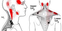 terapia trigger points-2