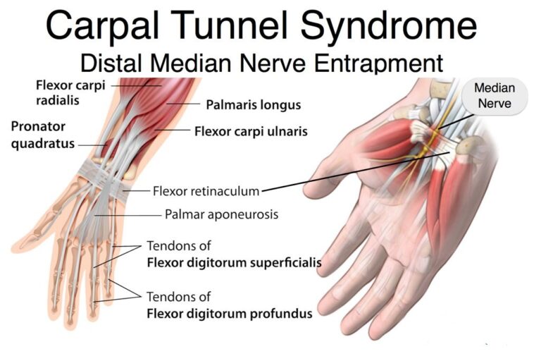 Sindromul de tunel carpian