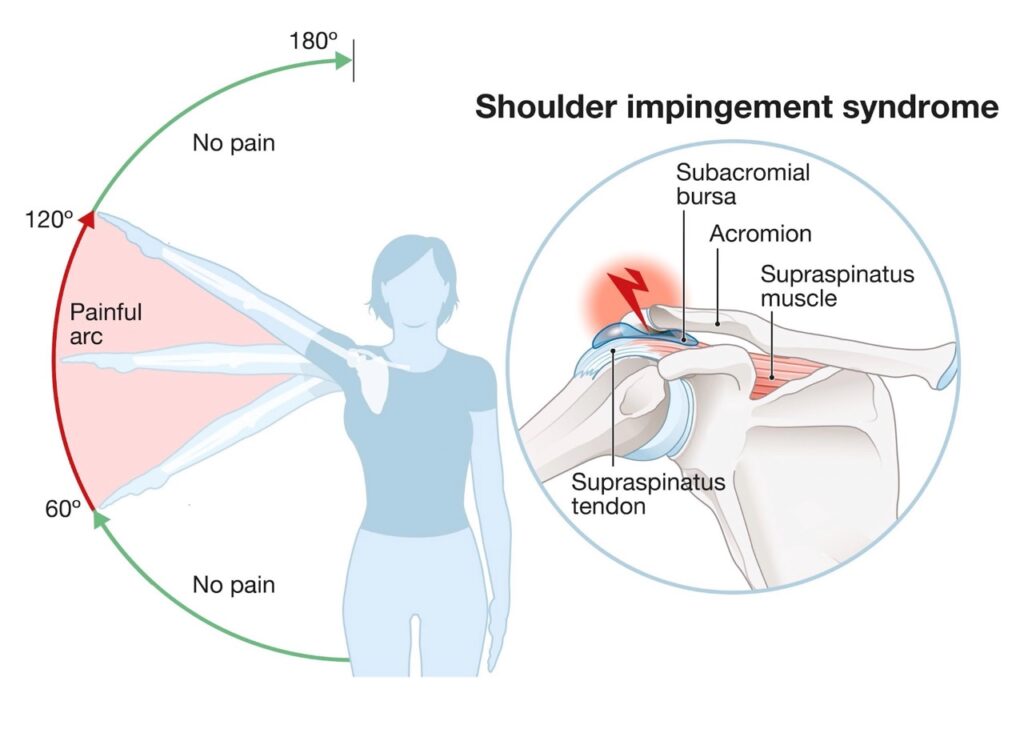 Sindromul de impingement