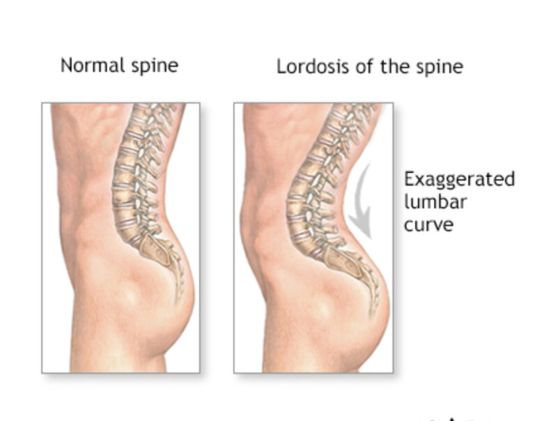 Hiperlordoza lombară