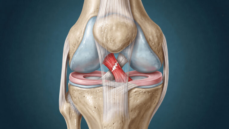 Leziunile ligamentului încrucişat anterior (LIA)